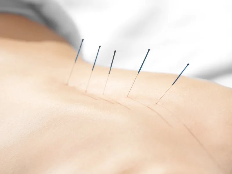 Acupuncture at ABC Chiropractic in Hudsonville