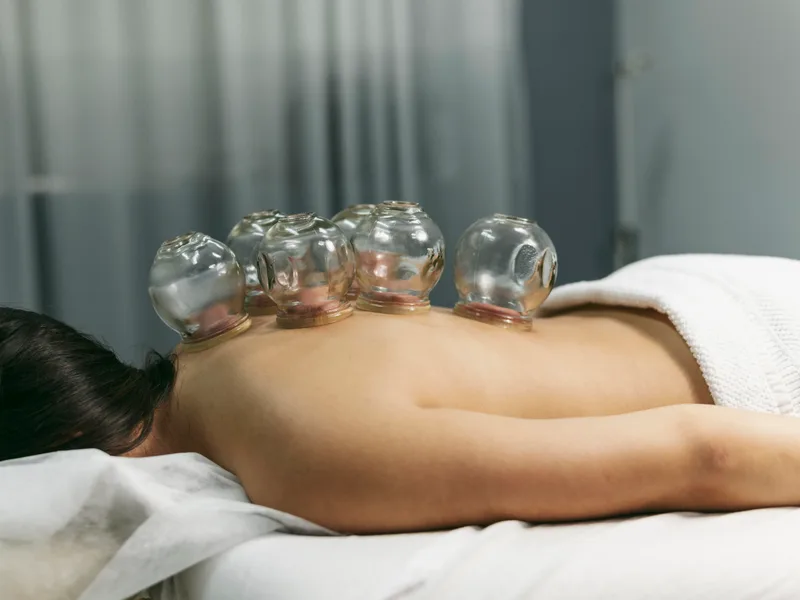Cupping Therapy at ABC Chiropractic in Hudsonville