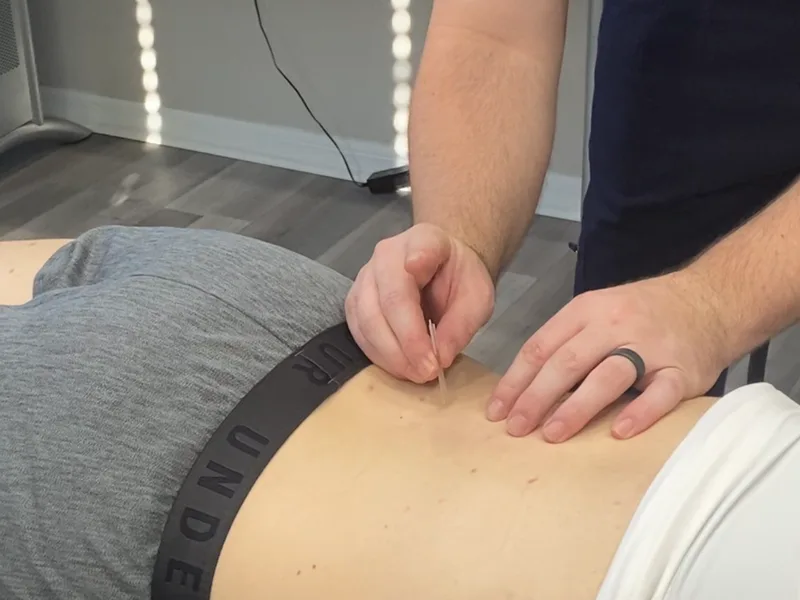 How Dry Needling works at ABC Chiropractic