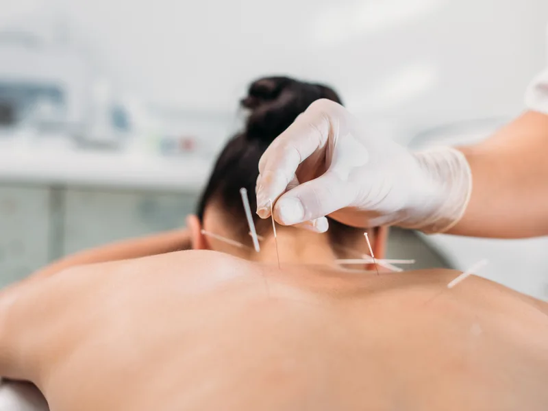 Dry Needling at ABC Chiropractic in Hudsonville